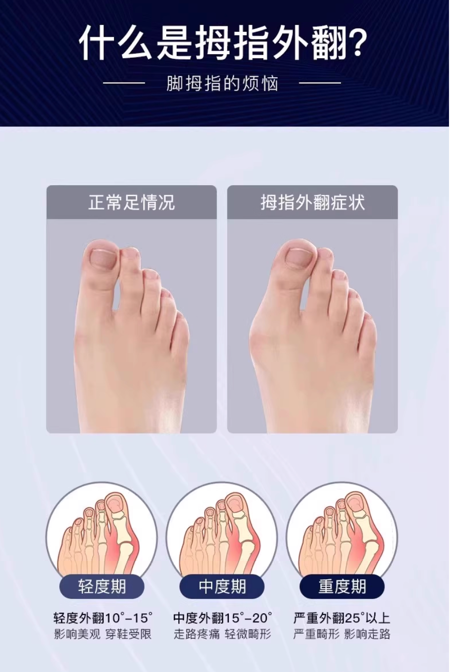 大拇指外翻矯正器