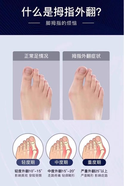 大拇指外翻矯正器