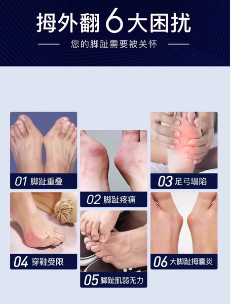 大拇指外翻矯正器