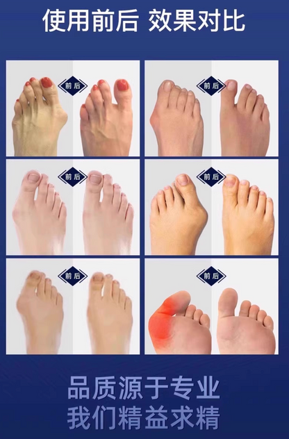 大拇指外翻矯正器