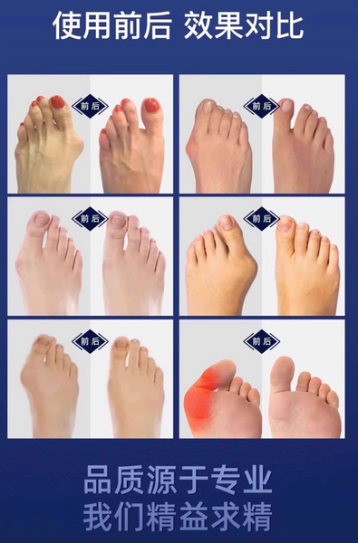 大拇指外翻矯正器