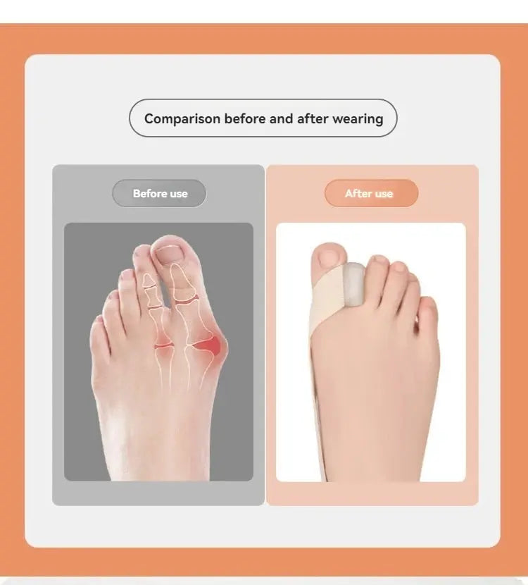 拇指外翻腳趾矯正器 (日夜用及可穿鞋)