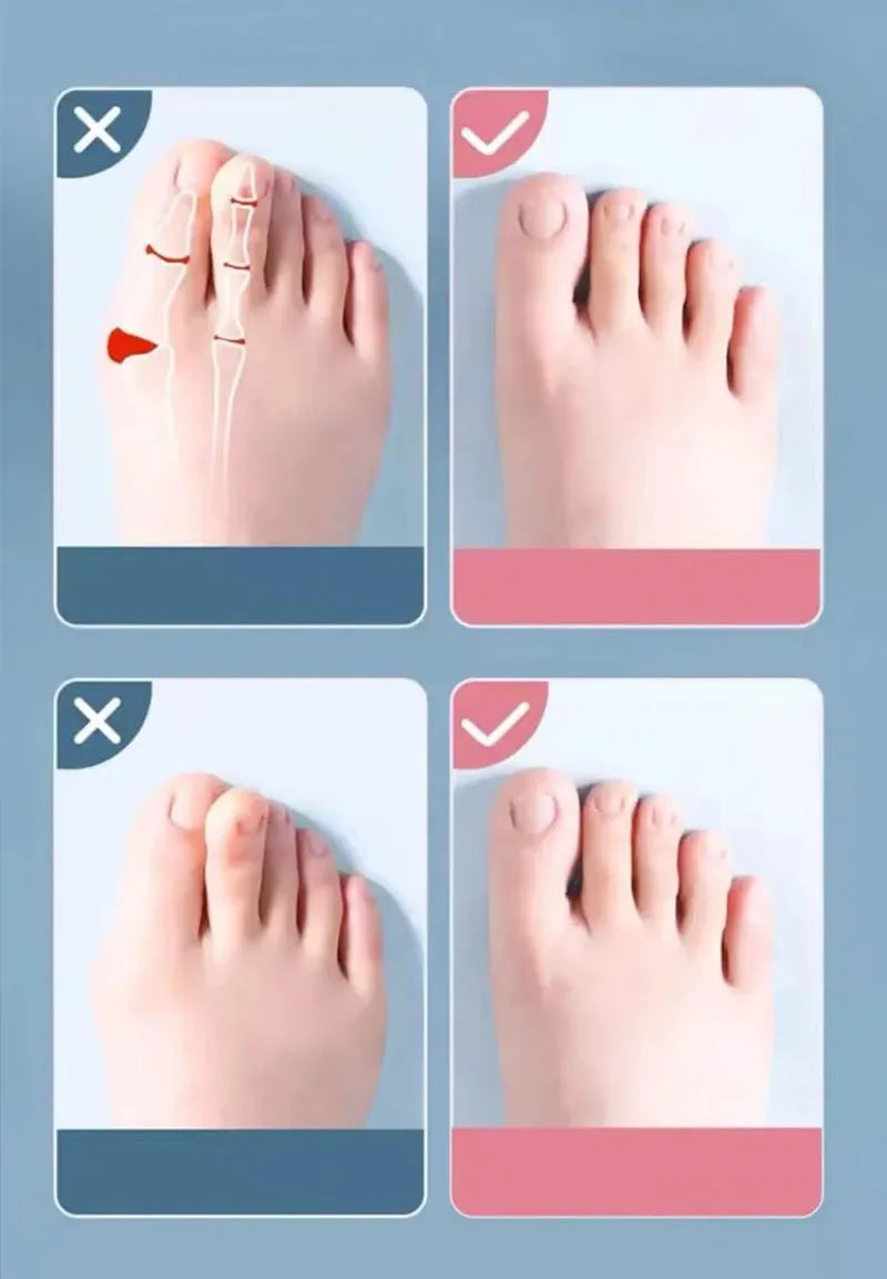 腳趾重疊分離器 