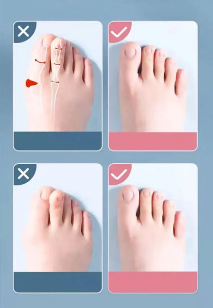 腳趾重疊分離器 